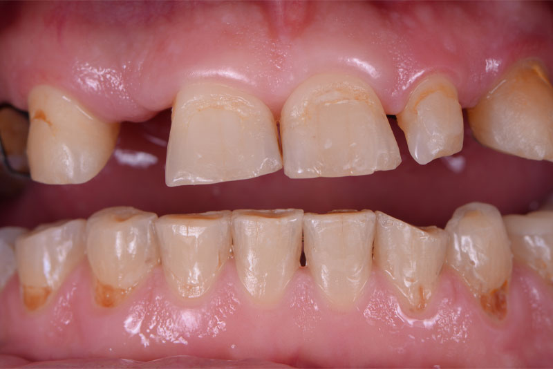 before dental procedure