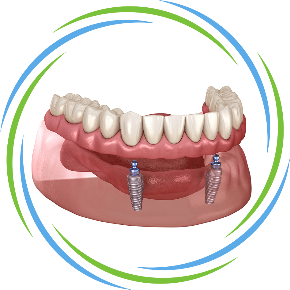 implant supported dentures