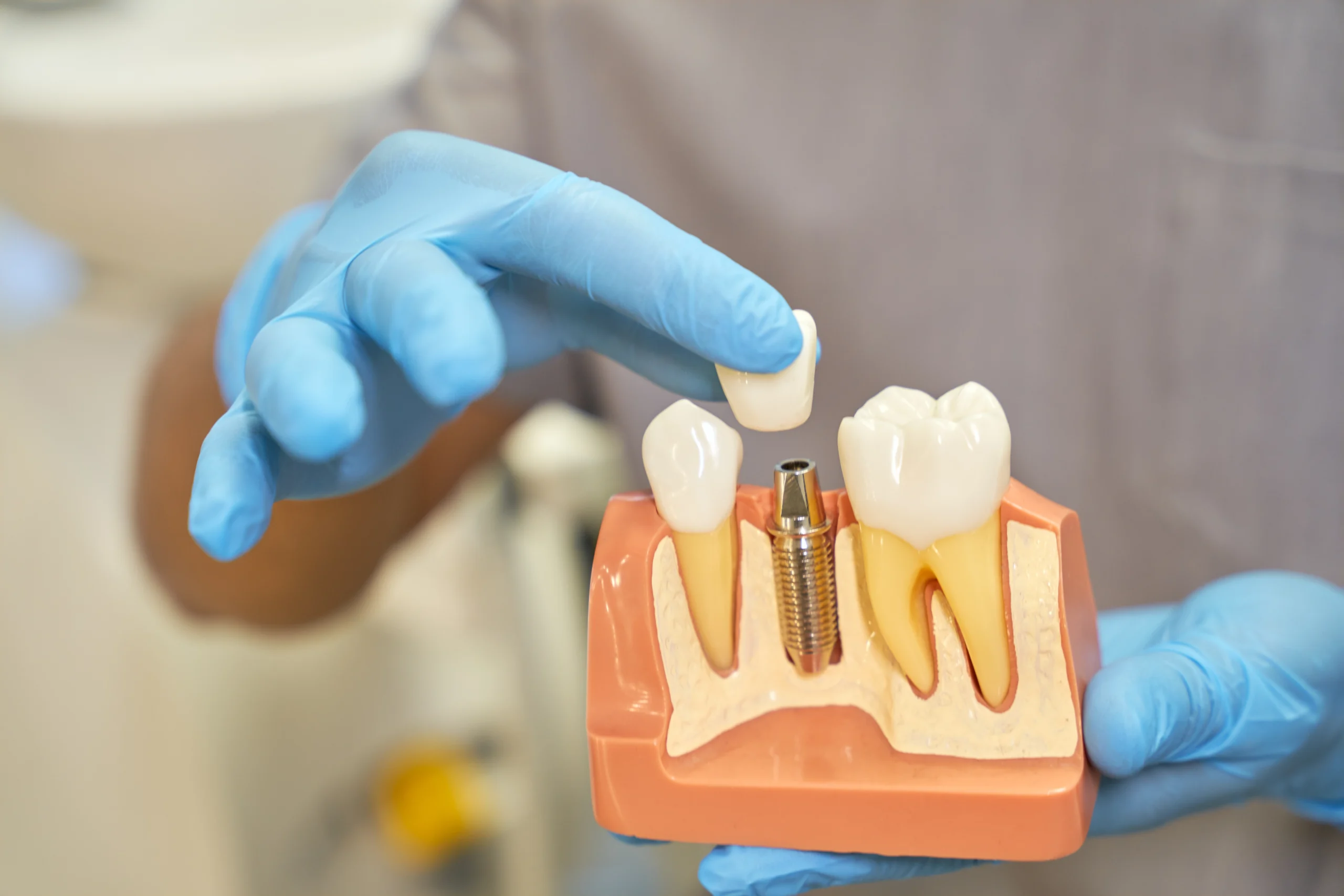 How Long Do Dental Implants Last