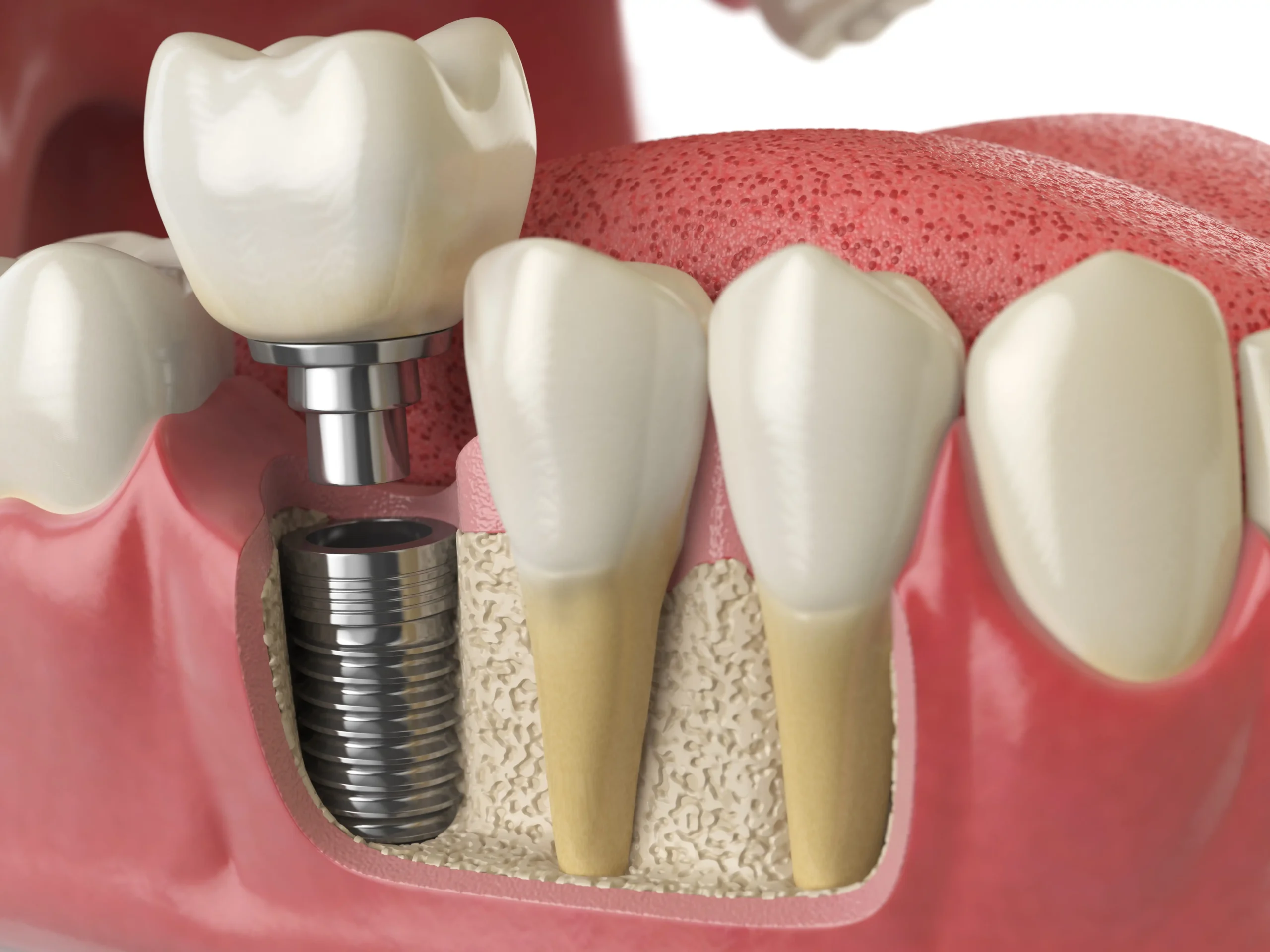What Are the 3 Types of Dental Implants