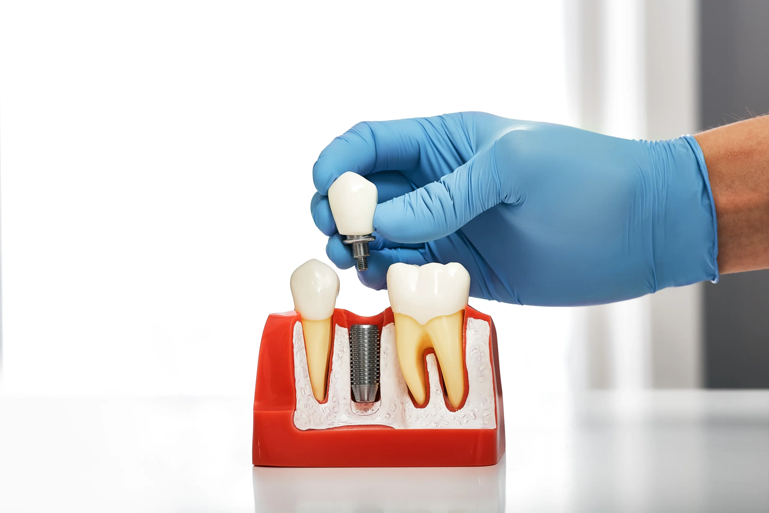 How Much Do Dental Implants Cost in California