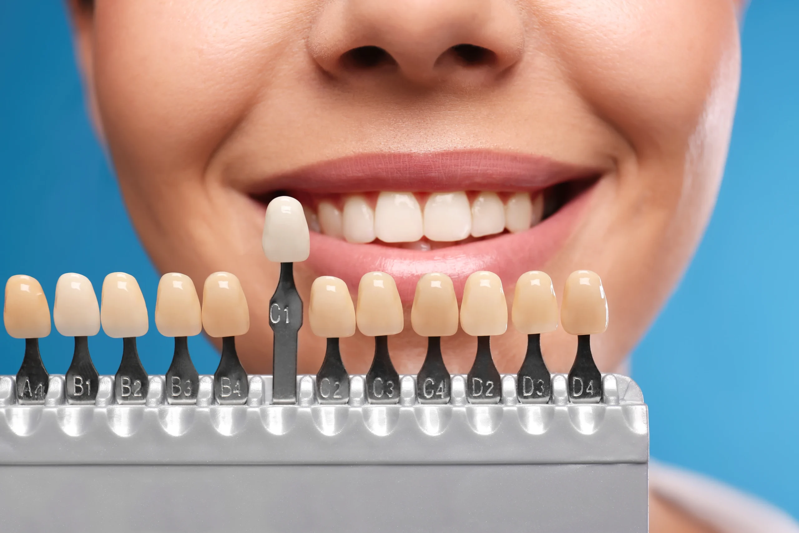 Veneers vs. Crowns