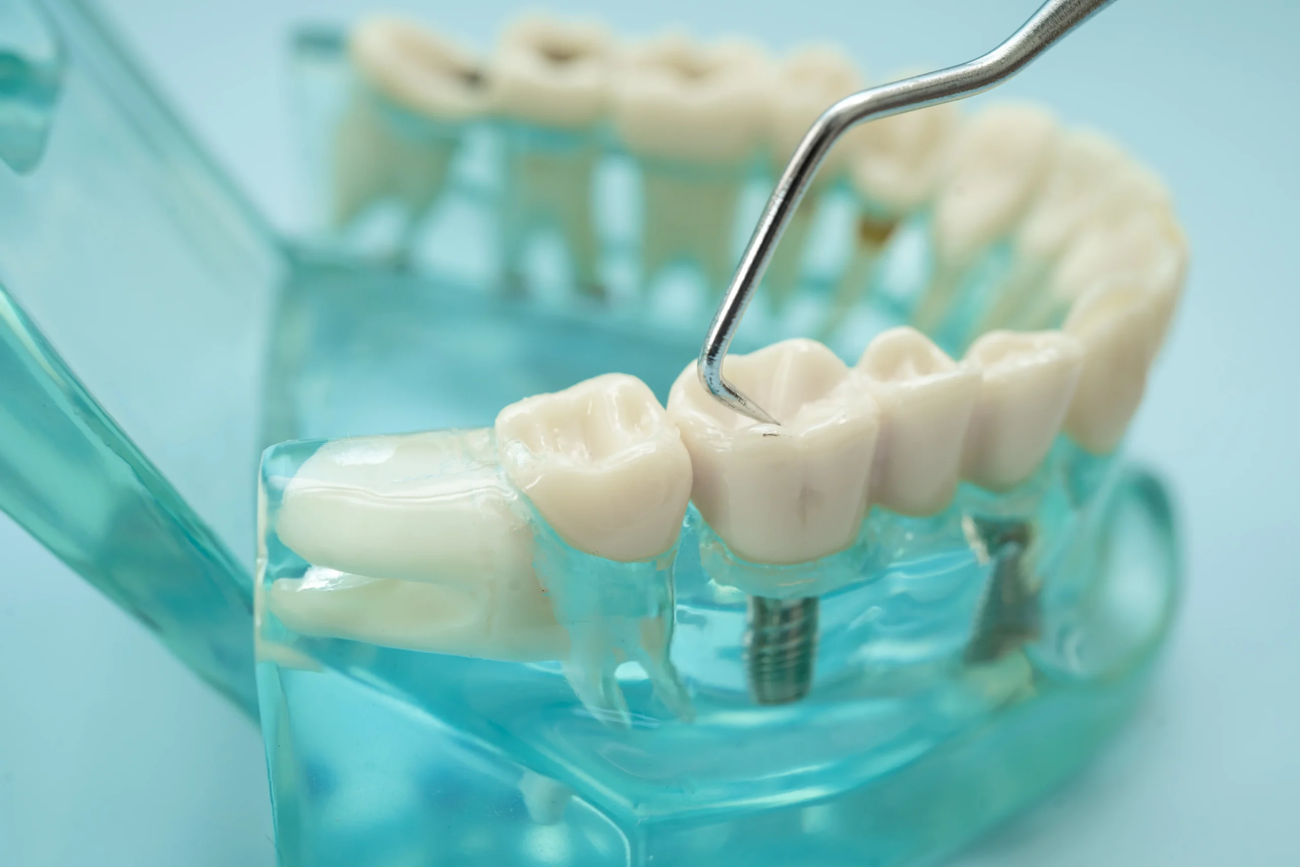 Are Dental Implants Painful