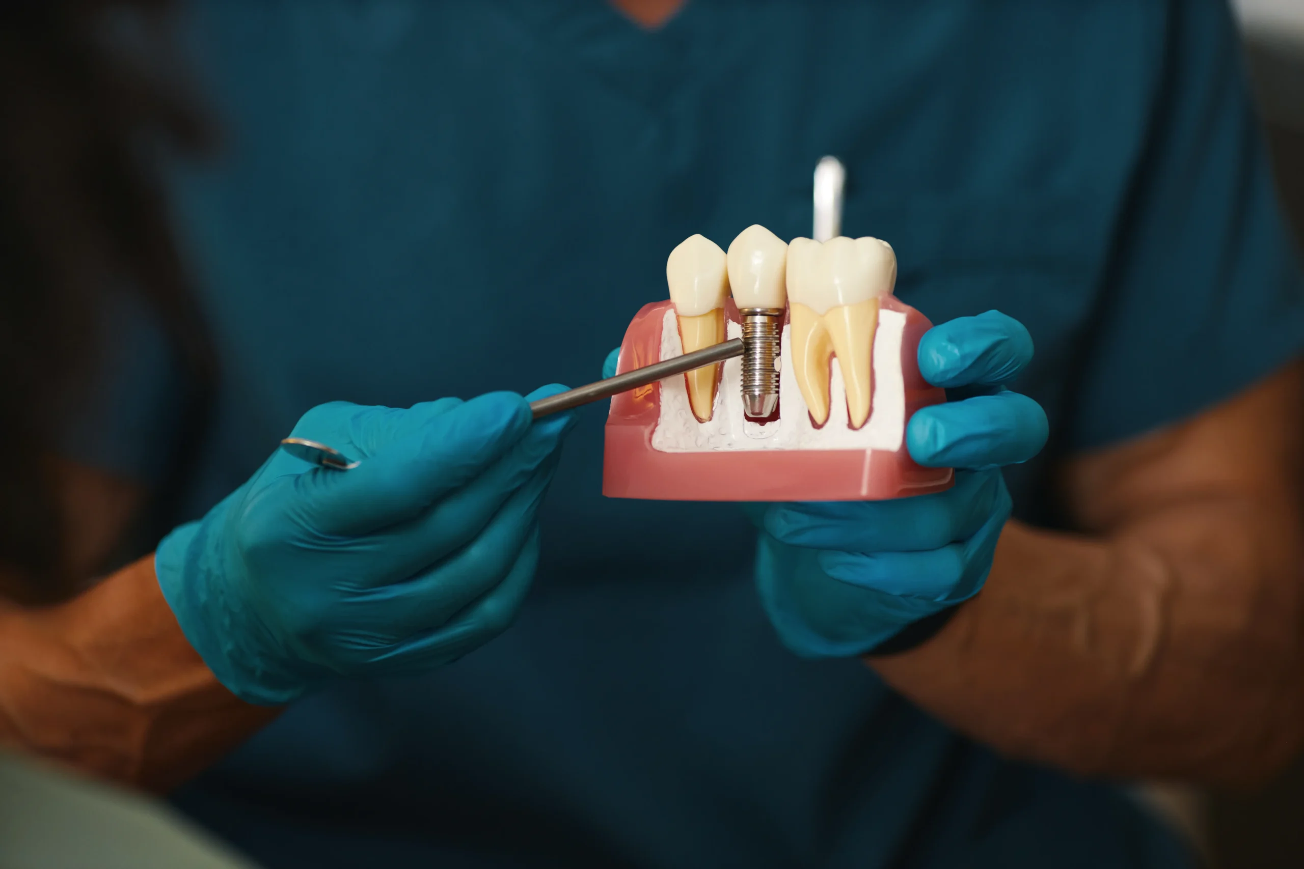 Can You Get Dental Implants With Bone Loss